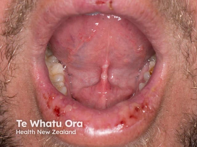 Лабиальный герпес (Herpes simplex labialis)