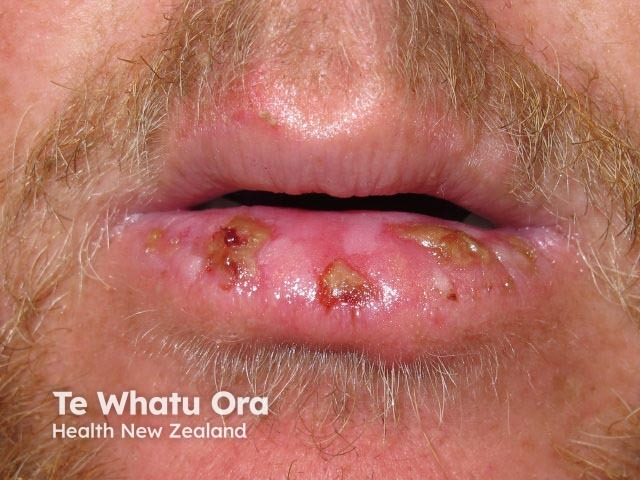 Лабиальный герпес (Herpes simplex labialis)