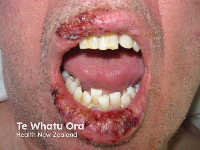 Лабиальный герпес (Herpes simplex labialis)