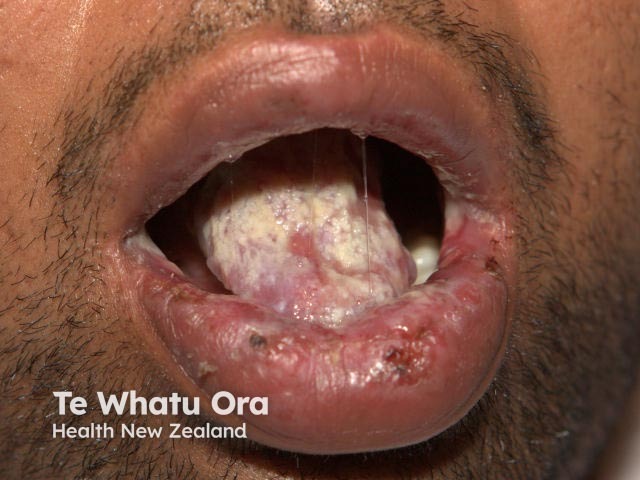 Лабиальный герпес (Herpes simplex labialis)