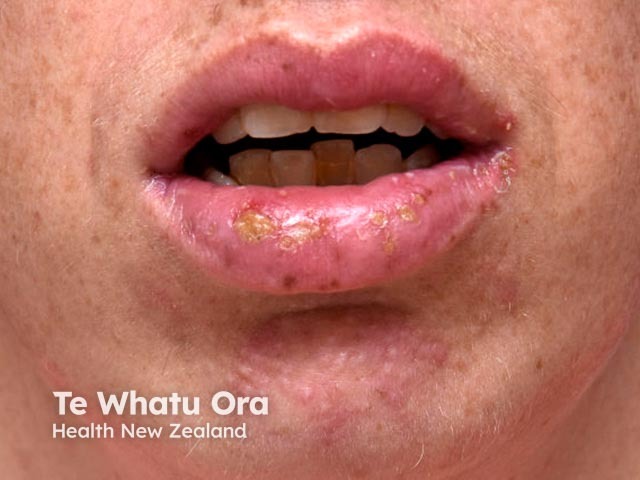 Лабиальный герпес (Herpes simplex labialis)