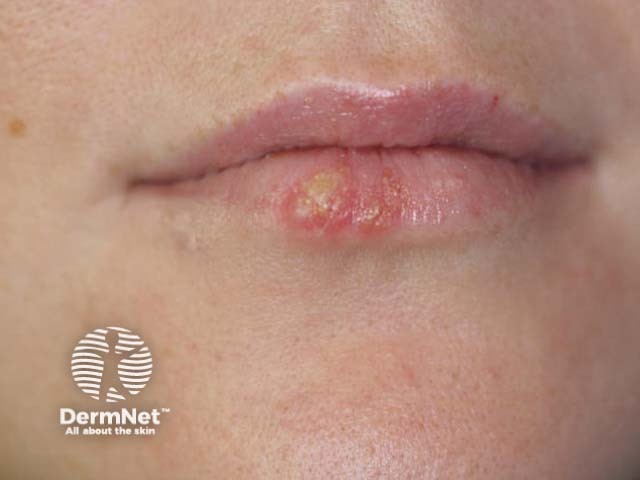 Лабиальный герпес (Herpes simplex labialis)