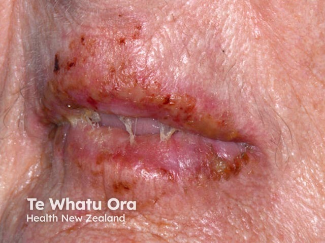 Лабиальный герпес (Herpes simplex labialis)