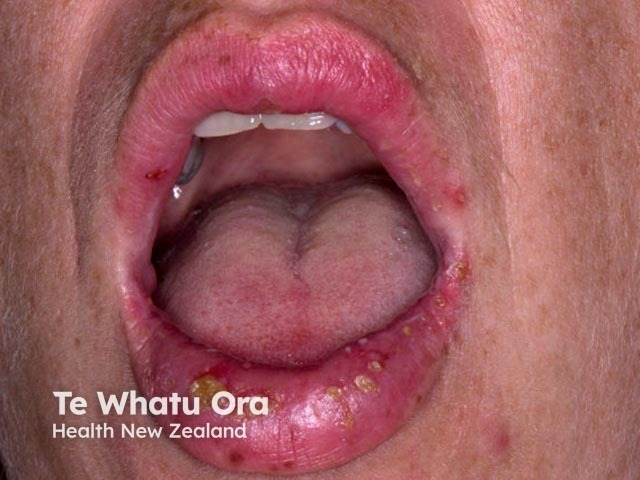 Лабиальный герпес (Herpes simplex labialis)