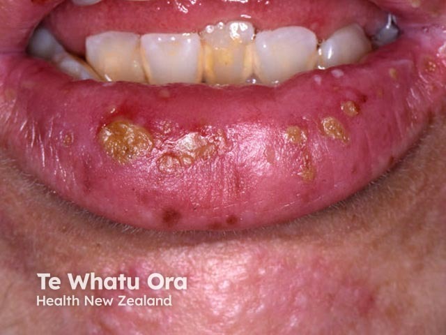 Лабиальный герпес (Herpes simplex labialis)