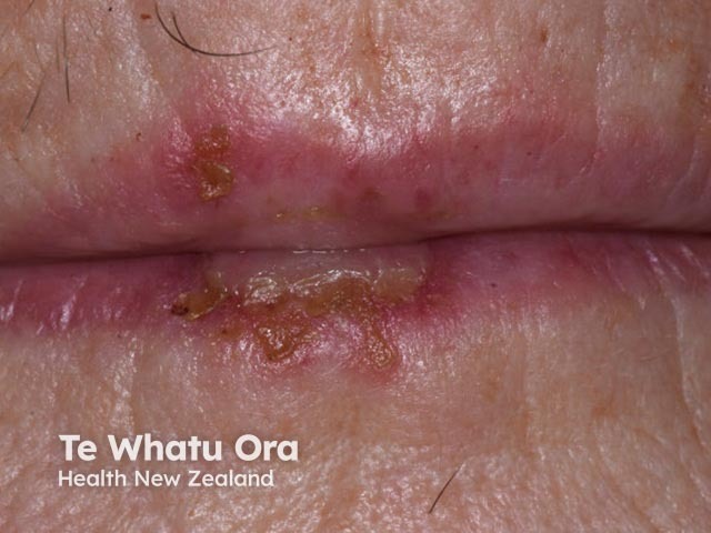 Лабиальный герпес (Herpes simplex labialis)