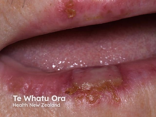 Лабиальный герпес (Herpes simplex labialis)