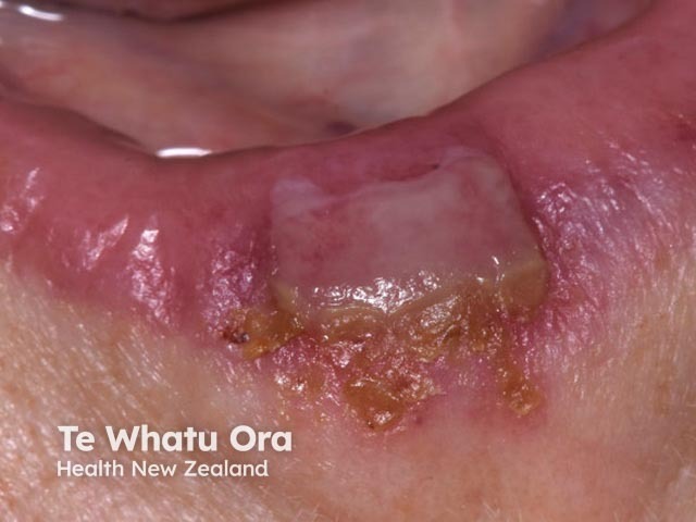 Лабиальный герпес (Herpes simplex labialis)