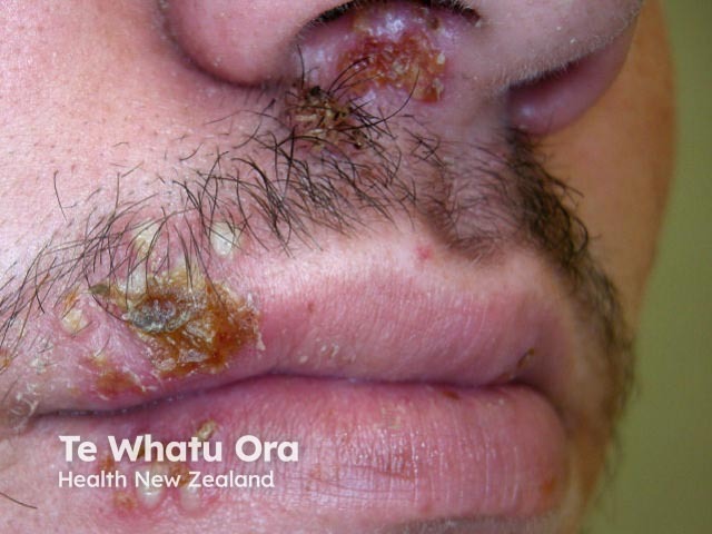 Лабиальный герпес (Herpes simplex labialis)