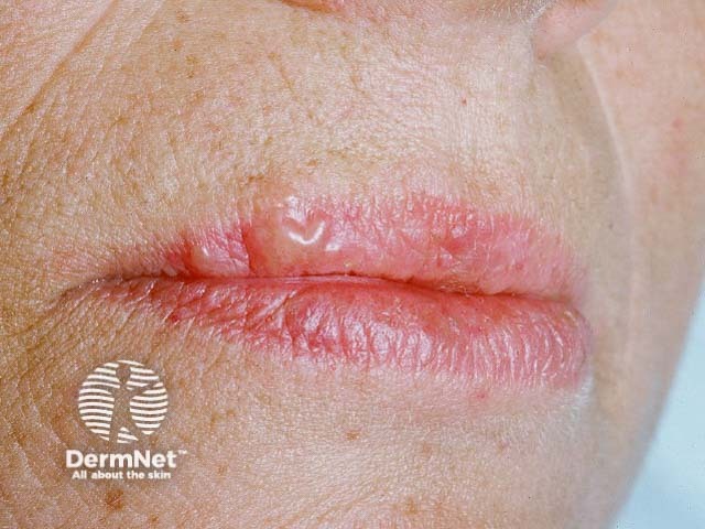 Лабиальный герпес (Herpes simplex labialis)