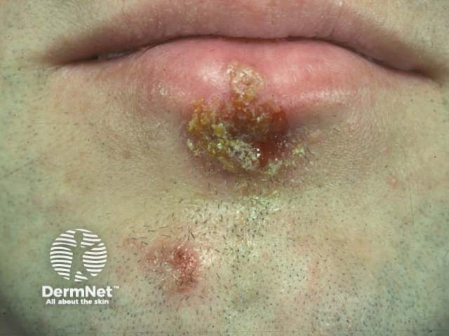 Лабиальный герпес (Herpes simplex labialis)