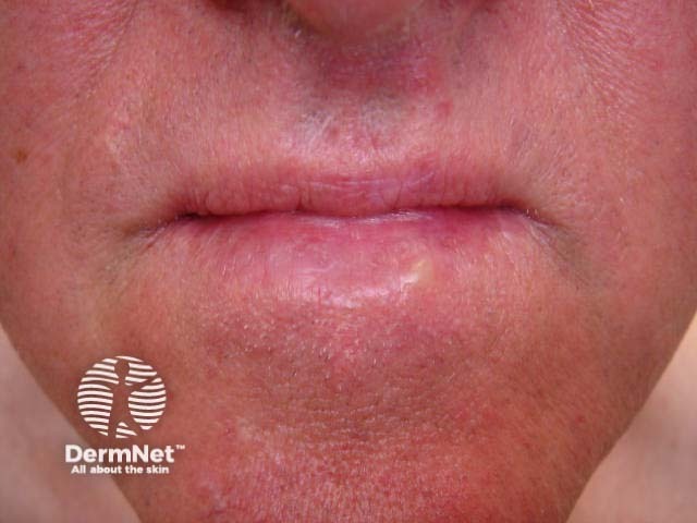 Лабиальный герпес (Herpes simplex labialis)
