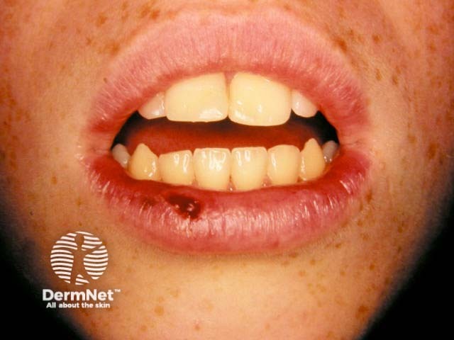 Лабиальный герпес (Herpes simplex labialis)