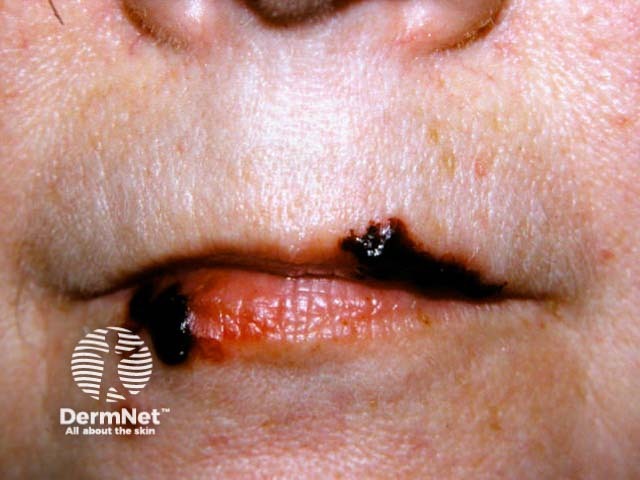 Лабиальный герпес (Herpes simplex labialis)