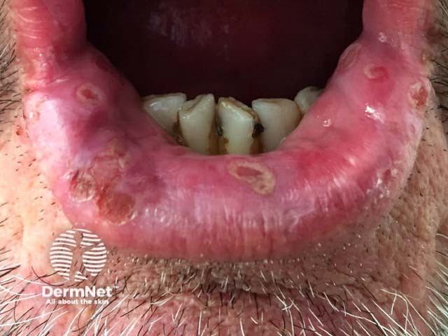 Лабиальный герпес (Herpes simplex labialis)