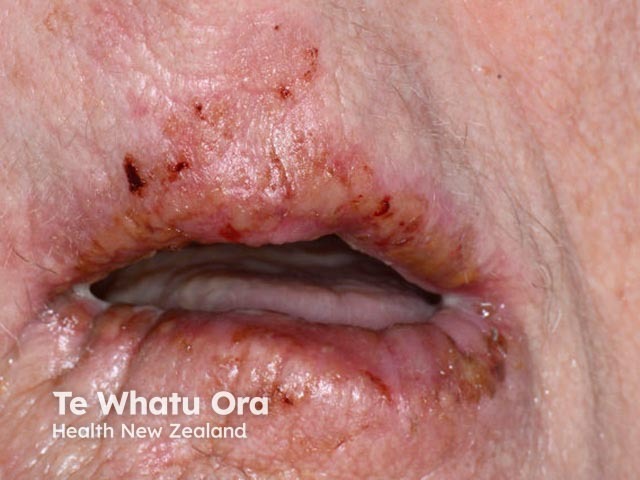 Лабиальный герпес (Herpes simplex labialis)