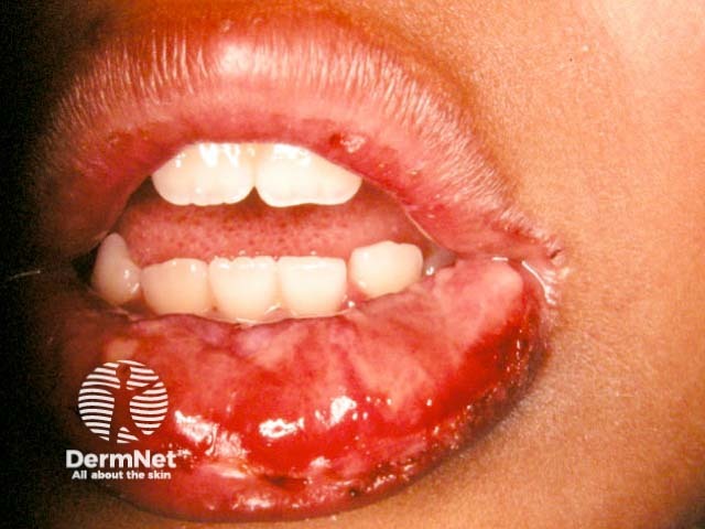 Лабиальный герпес (Herpes simplex labialis)