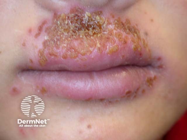 Герпетиформная экзема Капоши (Eczema herpeticum)