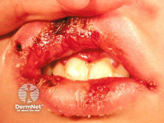 Лабиальный герпес (Herpes simplex labialis)