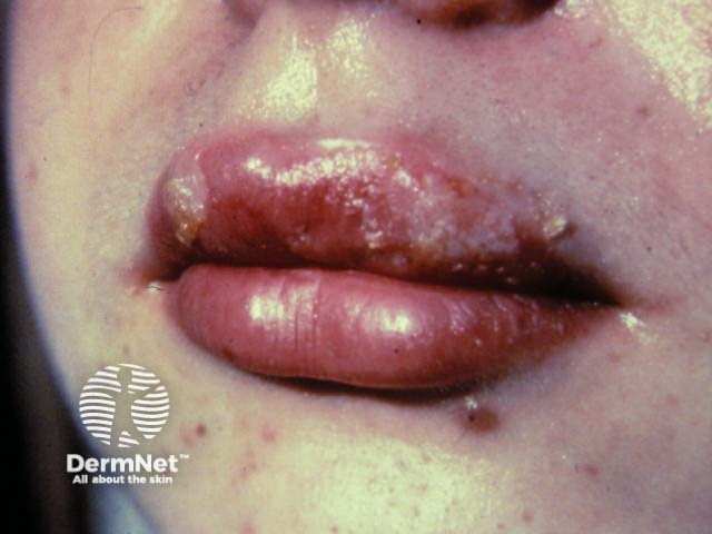 Лабиальный герпес (Herpes simplex labialis)