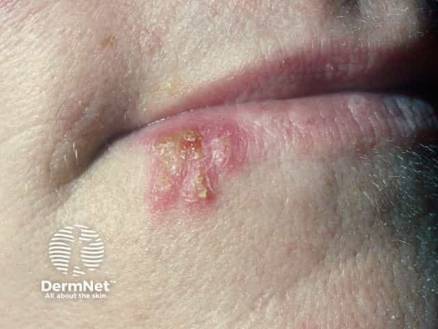 Лабиальный герпес (Herpes simplex labialis)
