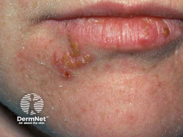 Лабиальный герпес (Herpes simplex labialis)