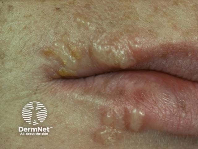 Лабиальный герпес (Herpes simplex labialis)