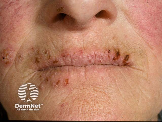 Лабиальный герпес (Herpes simplex labialis)