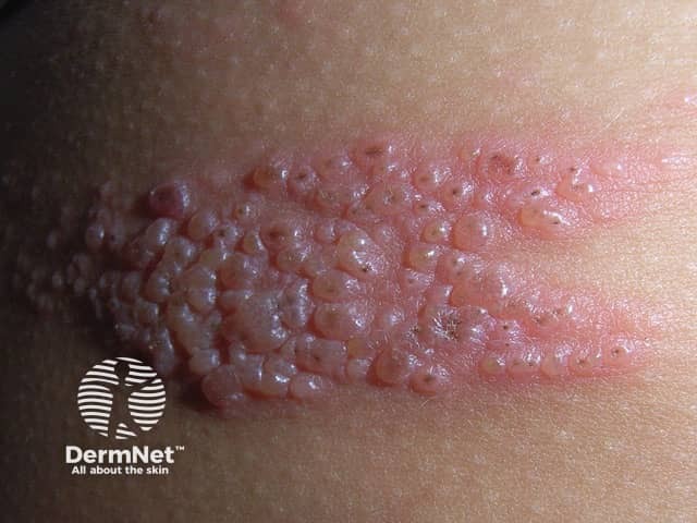 Опоясывающий лишай (shingles)