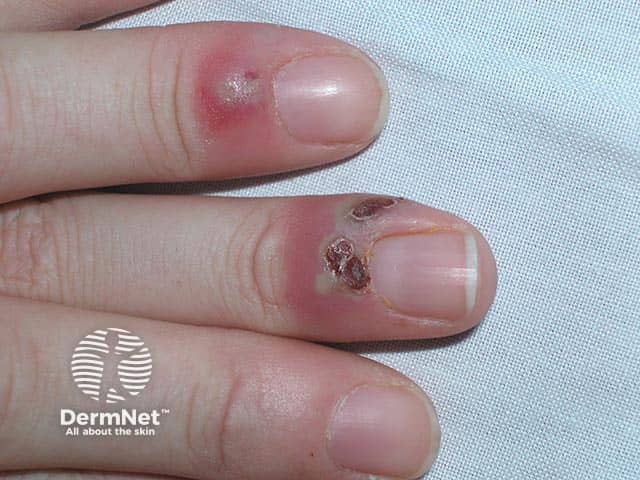 Поражение нескольких ногтевых валиков герпетическим панарицием у пациентки, получающей химиотерапию.