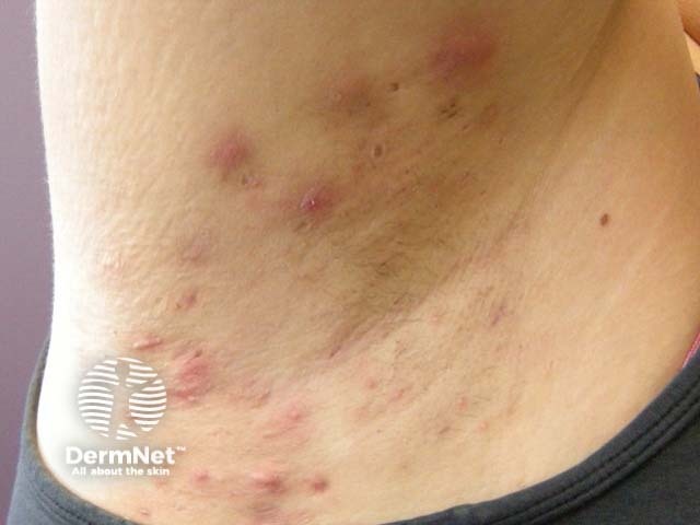 Гнойный гидраденит подмышечной впадины