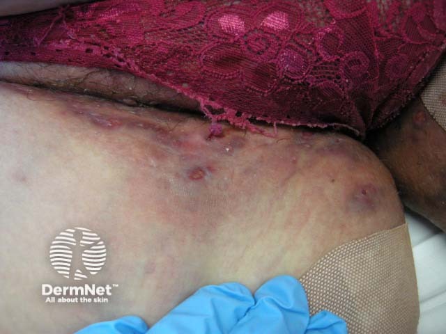 Гнойный гидраденит паховой области