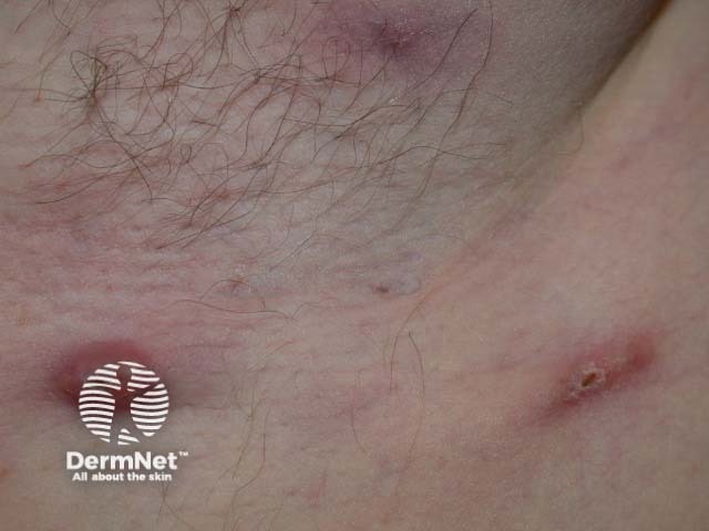 Воспалительный элемент при гнойном гидрадените