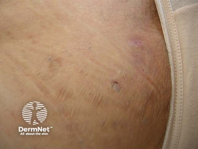 Рубцевание при гнойном гидрадените