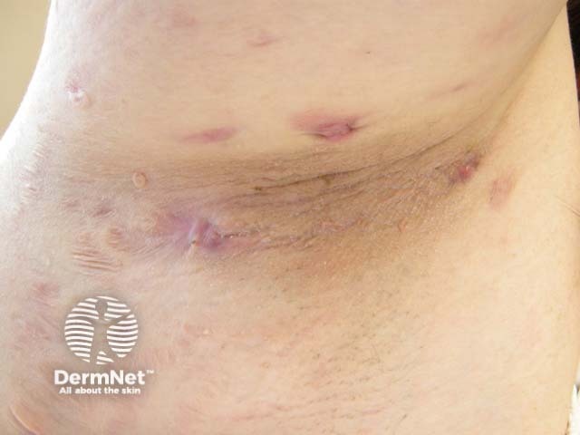 Гнойный гидраденит подмышечной впадины