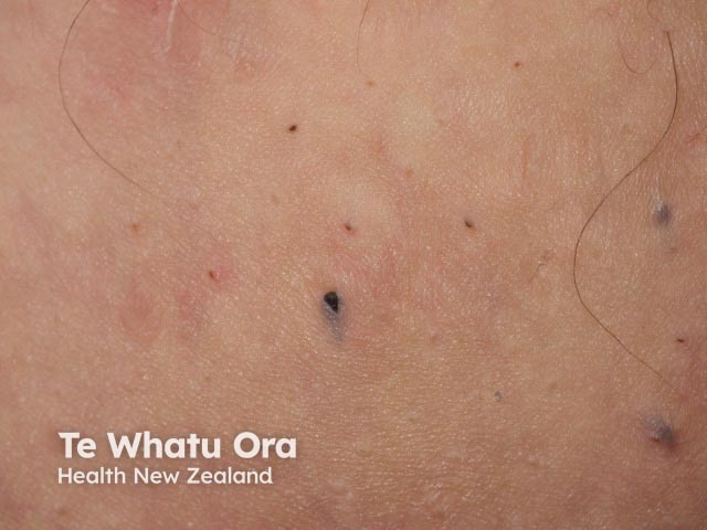Комедоны при гнойном гидрадените