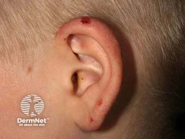 Ювенильное весеннее высыпание: эволюция высыпаний в эрозии и корки