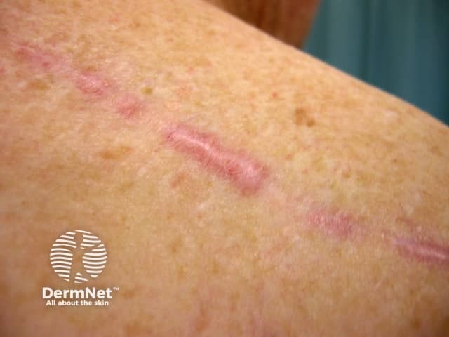 Гипертрофический рубец в верхней части спины: утолщение не выходит за границы повреждения