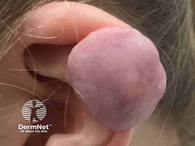 Келоид завитка ушной раковины после пирсинга