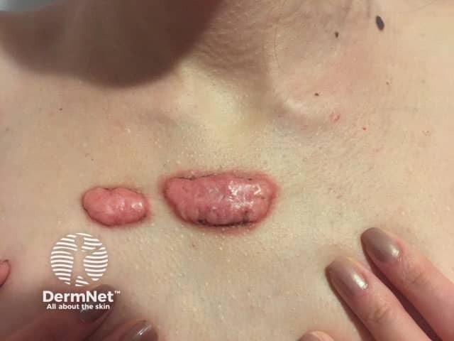 Келоидные рубцы постакне на груди перед иссечением и лучевой терапией