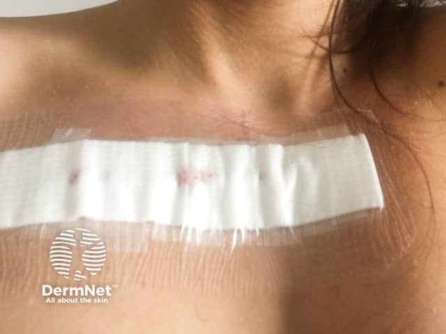Повязка после иссечения келоида, за 24 часа до проведения облучения