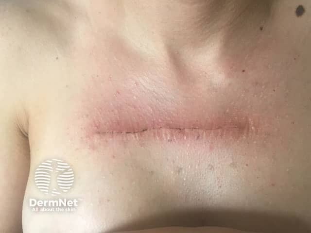 Десятый день после хирургического иссечения и радиотерапии келоидного рубца