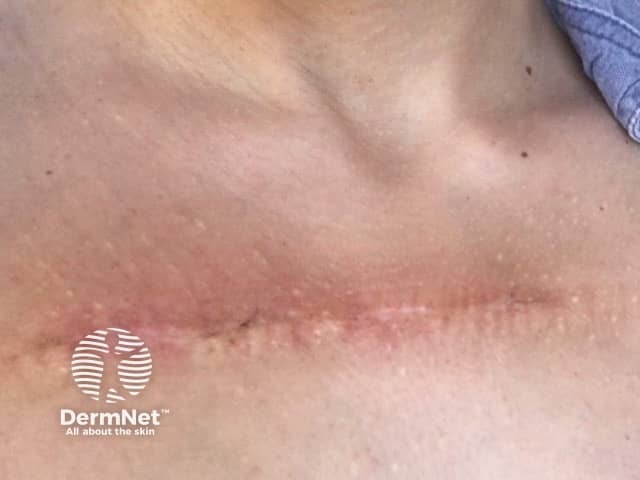 Две недели после иссечения и радиотерапии келоида грудной клетки