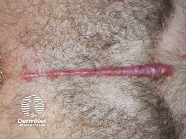 Послеоперационный рубец после аортокоронарного шунтирования