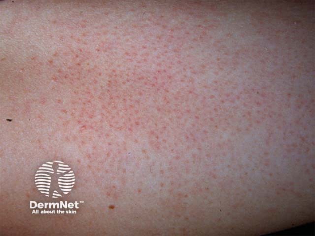 Фолликулярный кератоз (Keratosis pilaris)