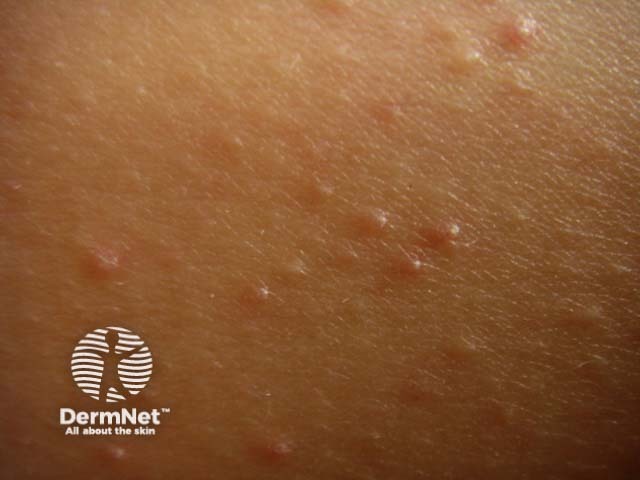 Фолликулярный кератоз (Keratosis pilaris)