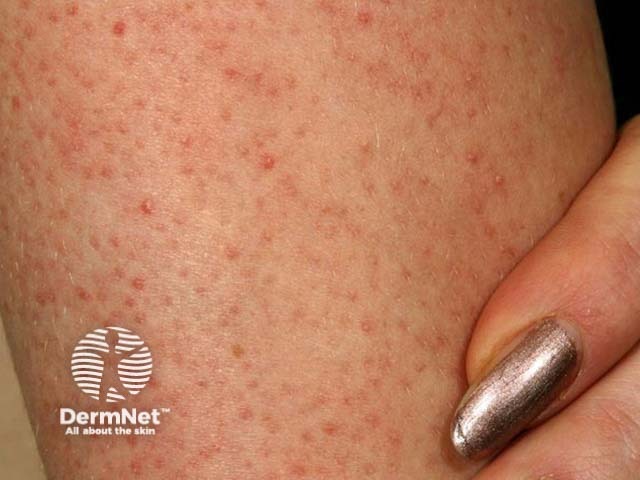 Фолликулярный кератоз (Keratosis pilaris)