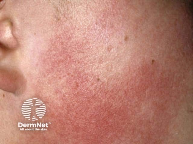 Красный фолликулярный кератоз лица (Keratosis pilaris rubra faciei)