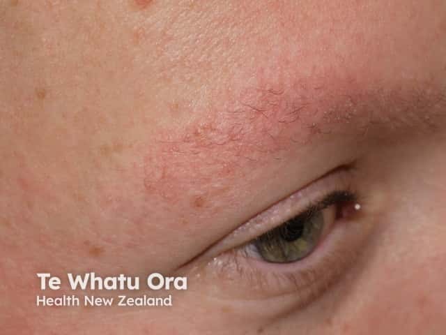 Надбровная рубцующаяся эритема (Ulerythema ophryogenes)