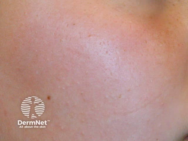 Червеобразная атрофодермия (Atrophoderma vermiculata)